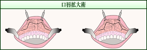 口唇拡大術(イメージ)