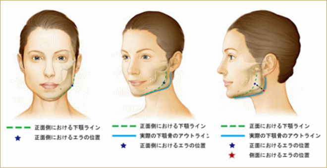 エラ 張り 骨 が 原因